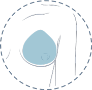 Breast augmentation with breast implants vs fat grafting, icon 1