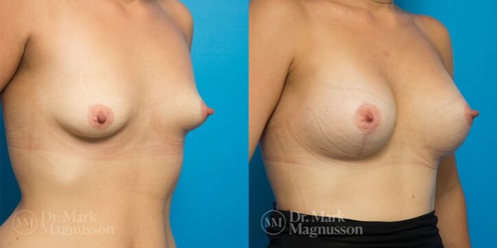 Breast_Asymmetry_Correction_2_