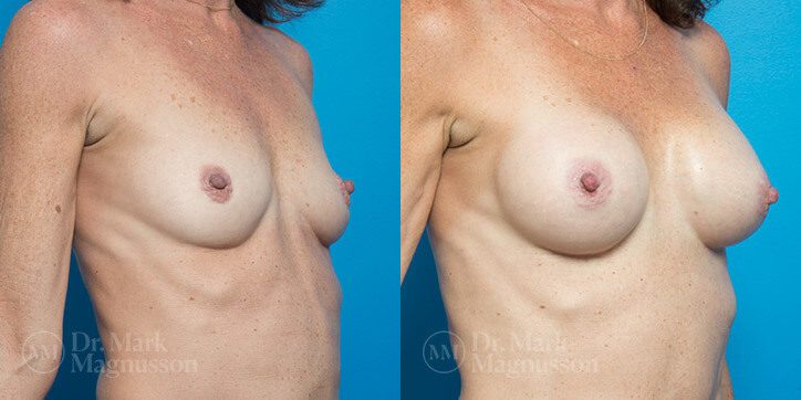 Breast_Augmentation_10_