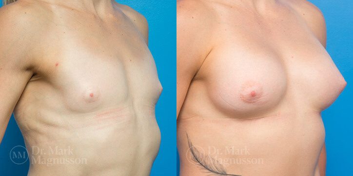 Breast_Augmentation_13_