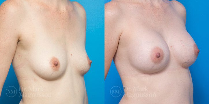 Breast_Augmentation_16_