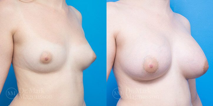 Breast_Augmentation_18_