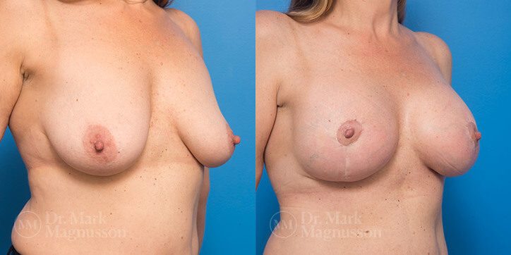 Breast_Augmentation_1_
