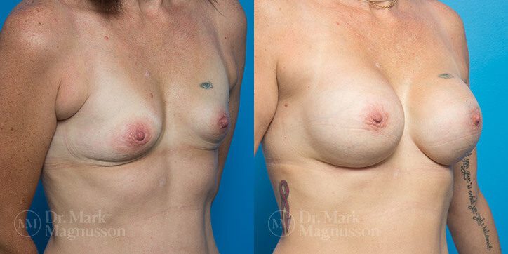 Breast_Augmentation_20_