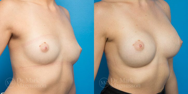 Breast_Augmentation_27_