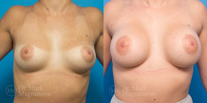 Breast_Augmentation_30_