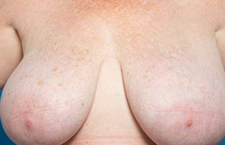 Reduction mammoplasty surgery before and after 02b, before, front view, Dr Magnusson