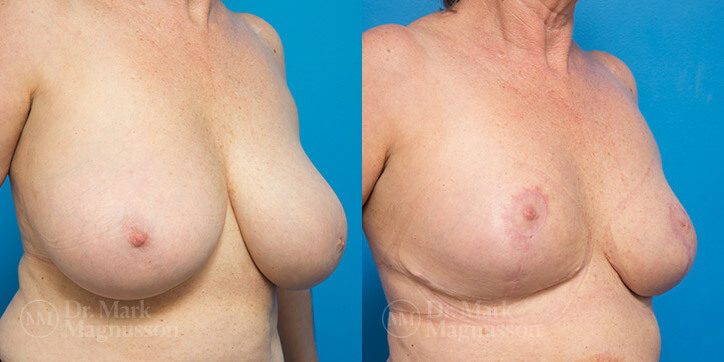 Breast_Reduction_13_