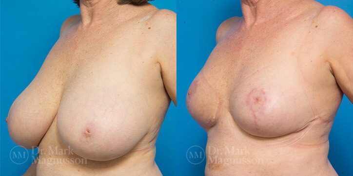 Breast_Reduction_3_