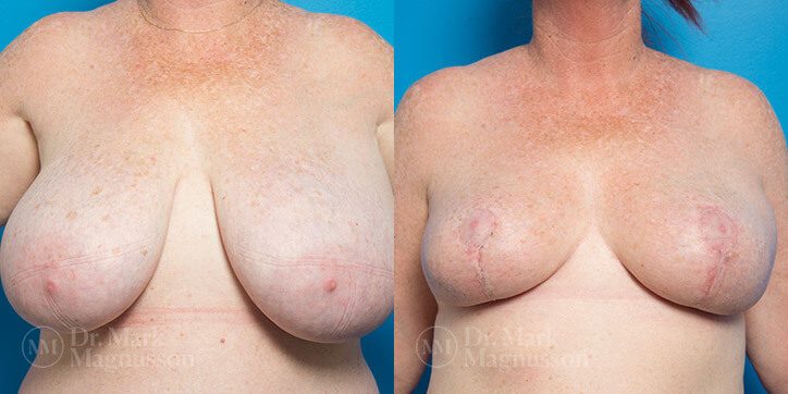 Breast_Reduction_5_