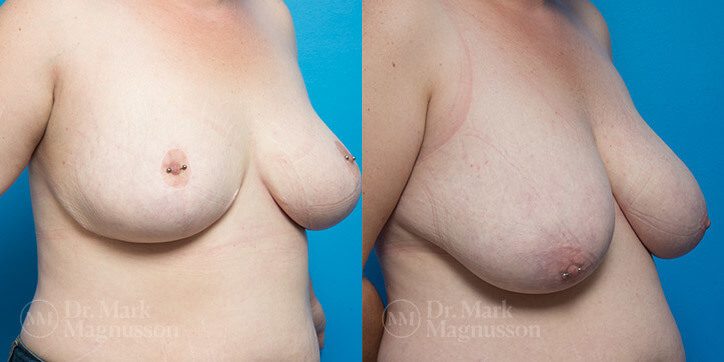 Breast_Reduction_8_