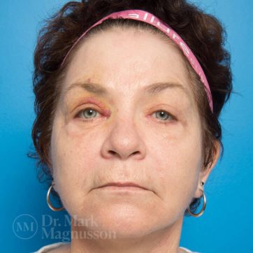 Facelift before and after 1A, female patient after the surgery (results), front, view, Dr Magnusson Toowoomba & Gold Coast