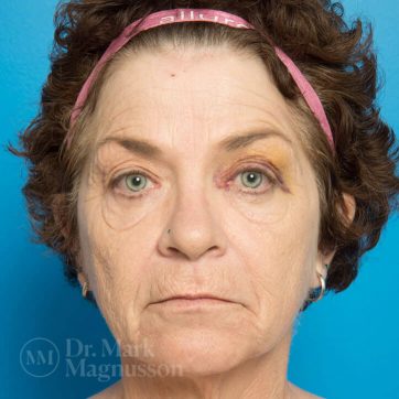 Facelift before and after 1B, female patient before the surgery, Dr Magnusson Toowoomba & Gold Coast
