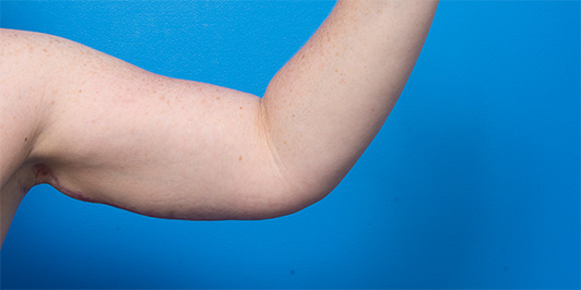 ARM REDUCTION/BRACHIOPLASTY, before and after gallery, Dr Magnusson Toowoomba & Gold Coast 