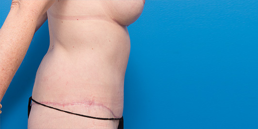 Body Lift, before and after gallery, Dr Magnusson, Toowoomba and Gold Coast Plastic Surgery