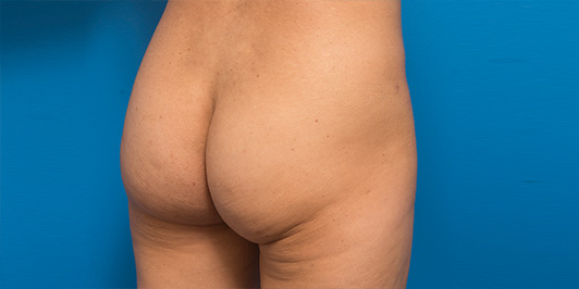 Butt lift surgery, before and after gallery, Dr Magnusson