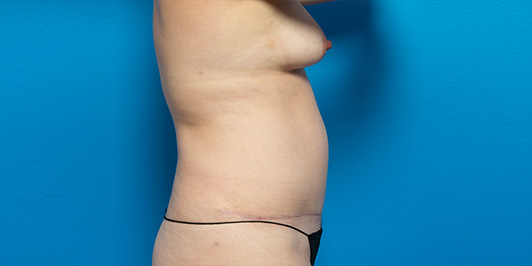 Liposuction before and after gallery, patient before the procedure, Dr Magnusson, Specialist Plastic Surgeon