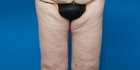 Thigh Reduction/Thighplasty, before and after gallery, patient before the surgery, Dr Magnusson