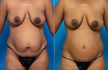 Adominoplasty Mesh Repair - 2