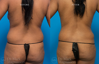 Adominoplasty Mesh Repair - 3