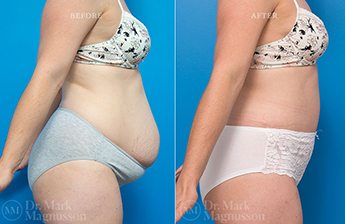 Adominoplasty Mesh Repair - 5