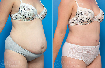 Adominoplasty Mesh Repair - 6