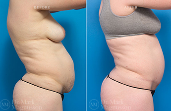 Adominoplasty Mesh Repair - 8