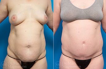 Adominoplasty Mesh Repair - 9