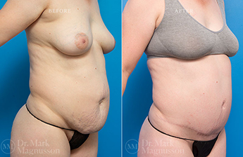 Adominoplasty Mesh Repair - 10