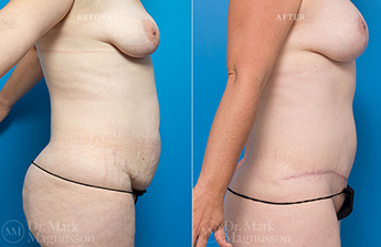 Adominoplasty Mesh Repair - 11