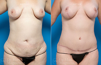 Adominoplasty Mesh Repair - 13