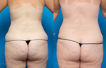 Adominoplasty Mesh Repair - 14