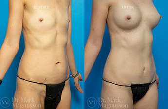 Abdominoplasty-Normal Weight - 1