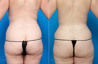 Abdominoplasty-Normal Weight - 4