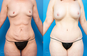 Abdominoplasty-Normal Weight - 10