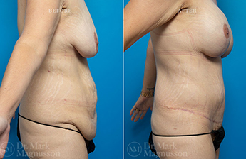 Abdominoplasty-Normal Weight - 15