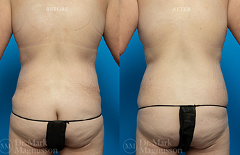Abdominoplasty-Normal Weight - 18