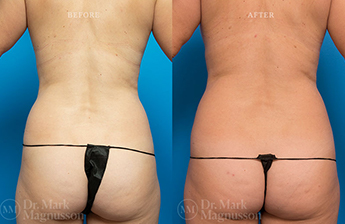 Abdominoplasty-Normal Weight - 22