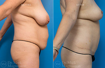 Abdominoplasty-Normal Weight - 23