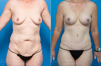 Abdominoplasty-Normal Weight - 27