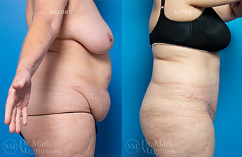 Abdominoplasty-Obese - 5