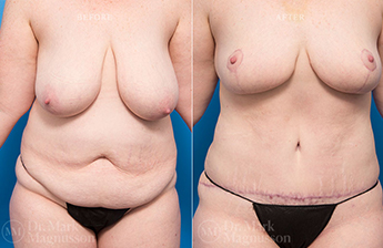 Abdominoplasty-Obese - 11