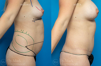 Abdominoplasty-Overweight - 1