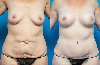Abdominoplasty-Overweight - 2