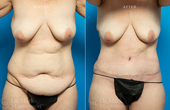 Abdominoplasty-Overweight - 7