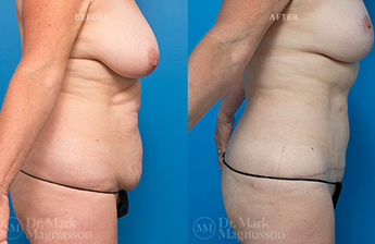 Abdominoplasty-Overweight - 9