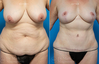 Abdominoplasty-Overweight - 11