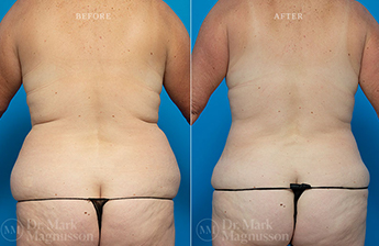 Abdominoplasty-Overweight - 12