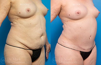 Abdominoplasty-Overweight - 14