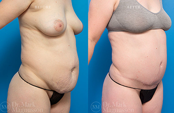 Abdominoplasty-Overweight - 17